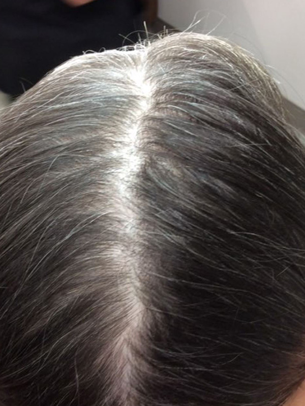 Before — patient 1
