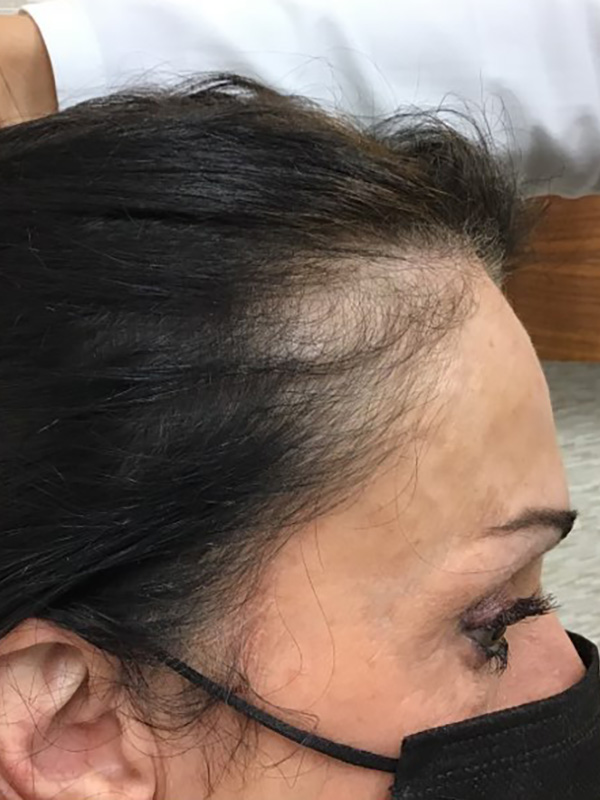 After — patient 3