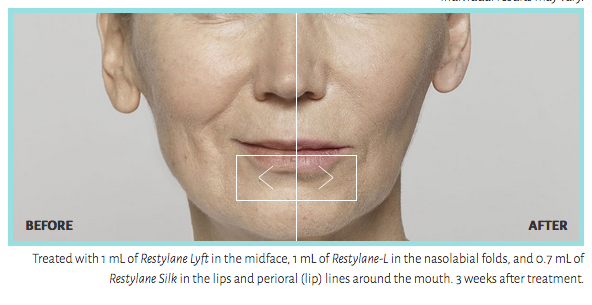 restylane