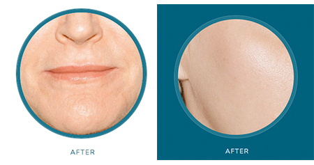 Radiesse® treatment