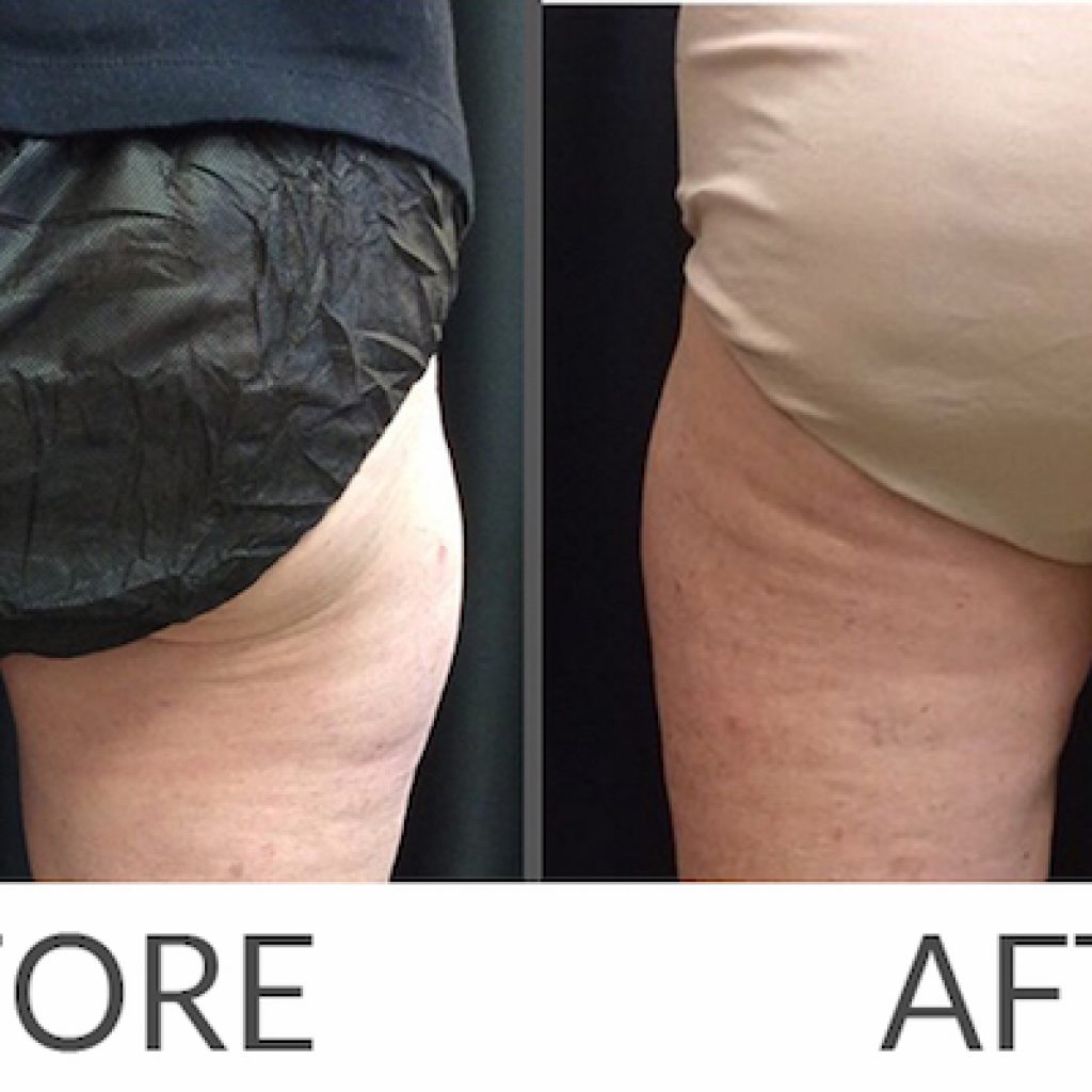 CoolSculpting Treatments in Hartford County Jennifer Pennoyer, MD