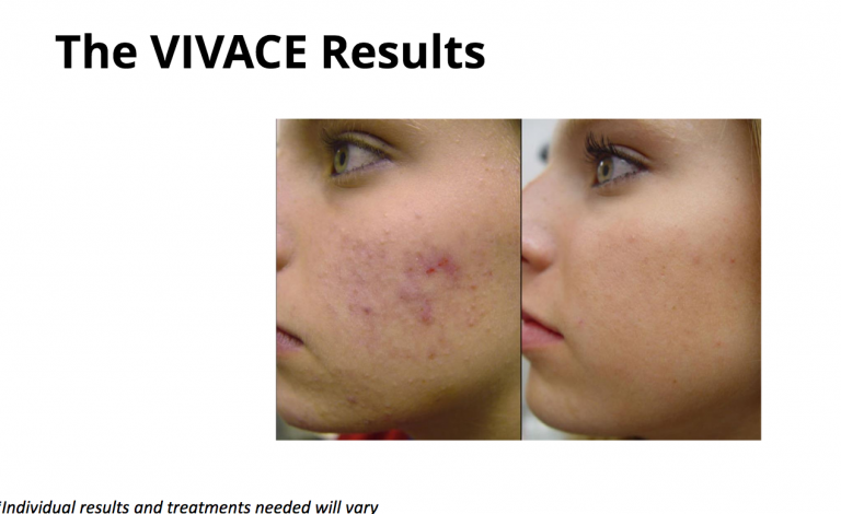 Vivace Microneedling Hartford County Jennifer Pennoyer, MD