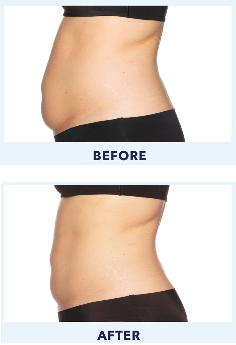 CoolSculpting Before and After Picture of Lower Abdomen - Connecticut Skin  Institute