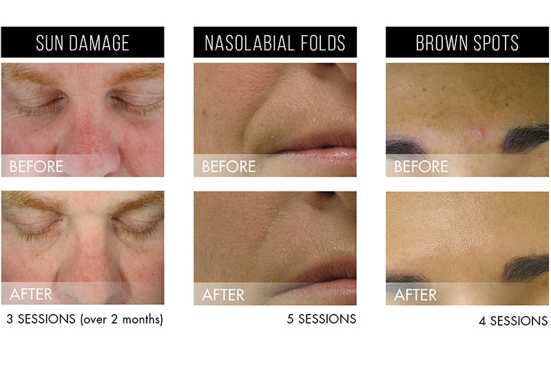 hydrafacial-before-after-2 hydrafacial-before-after-2