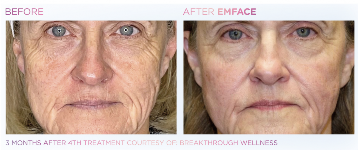 emface emface